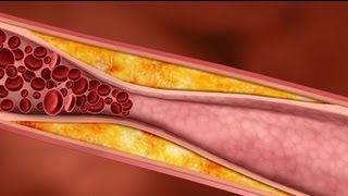 Cholesterol What are Plaques [upl. by Ebarta]