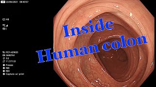 Inside Human Colon  Screening Colonoscopy How does it look like from endoscopist s view [upl. by Sachi]