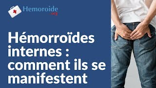 Hemoroide interne  tout comprendre sur les hemorroides internes [upl. by Annay890]