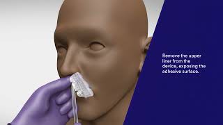 3M™ Nasogastric Securement Device Application and Removal Video [upl. by Guod334]