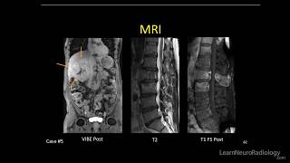 Neuroradiology spine lesions  Case 5  overview  Choose your own adventure [upl. by Redvers]