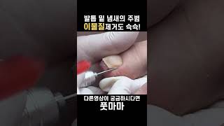 내성발톱이물질 발냄새 fungustoenail ingrowingtoenail [upl. by Cassiani]