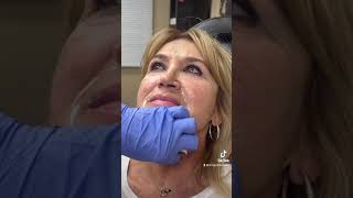 Botox Injection For Neck Bands [upl. by Trent711]