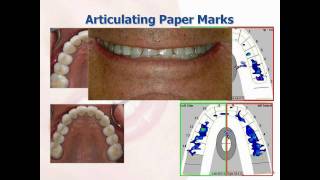 What is the TScan™ Computerized Occlusal Analysis System [upl. by Sussi]