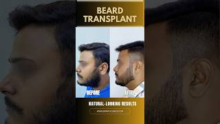 Beard Transplant Transformation By Dr Adarsh Tripathi  Sarayu Clinics hairtransplant [upl. by Thesda]