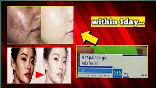 adaferin gel 01 reviews adaferin gel for acne scars [upl. by Josepha]