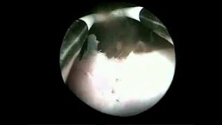 Hysteroscopic drainage of myometrial cystic adenomyosis [upl. by Ahsenot]