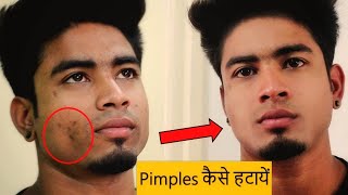 पिम्पल कैसे हटाये How To Remove Pimples  Wow Acne Treatment Kit Review FitnessFighters 2018 [upl. by Kitrak786]