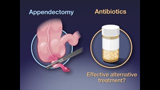 Antibiotika versus Appendektomie bei Appendizitis  NEJM 2020 [upl. by Trista]