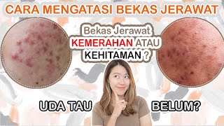 CARA MENGHILANGKAN BEKAS JERAWAT  KENALI DULU BEKAS JERAWAT [upl. by Rajewski]