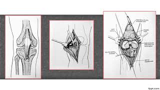 FRACTURAS DE PLATILLO TIBIAL [upl. by Knutson973]