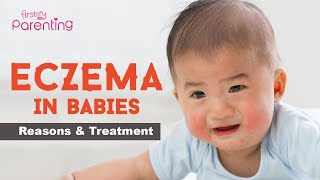 Baby Eczema  Causes Signs and Treatment [upl. by Airdna]