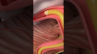 Thrombolysis Before Thrombectomy for Acute Ischemic Stroke [upl. by Sitelc]