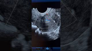 Endometrial Polyp Ultrasound with internal vascularity  ARDMS Sonography  obgyn [upl. by Kaylee]