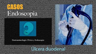 Úlcera duodenal [upl. by Charlet]