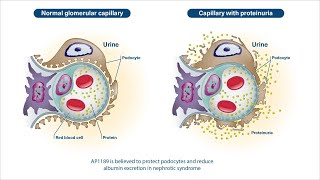 Membranous Nephropathy Types Causes and Mnemonics  Nephrotic Syndrome  Glomerulonephritis [upl. by Ellerrad]