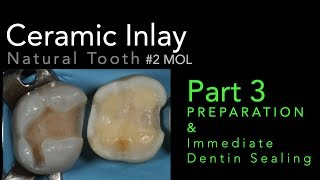 Lithium Disilicate Ceramics Part 3 Preparation and Immediate Dentin Sealing IDS [upl. by Flavius419]