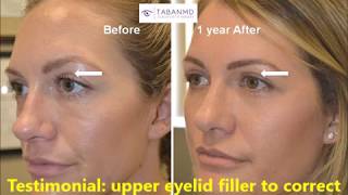 How to Remove Under Eye WRINKLES Under Eye Bags Puffy eyes amp Dark Circles in 1 Day with ice cubes [upl. by Aryek594]