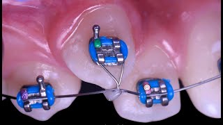 Distant ligature traction in orthodontics [upl. by Vaasta931]