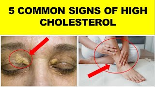 5 Common Signs and Symptoms Of High Cholesterol [upl. by Eenttirb]