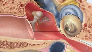 Repair a perforated ear drum using ClearDrum [upl. by Iraj]