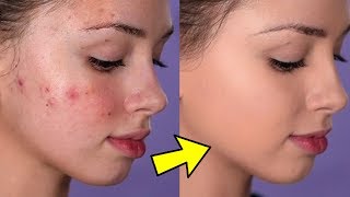 How To Cover Acne and Blemishes  EASY amp NONCAKEY [upl. by Alister861]