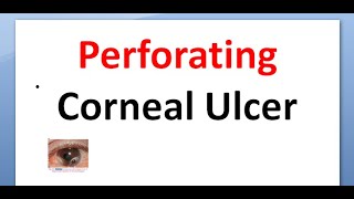 Fungal corneal ulcer treatment for eye fungus infection  A State of Sight 80 [upl. by Elie271]