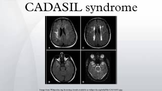 CADASIL syndrome [upl. by Rauscher]