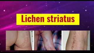 Lichen striatus overview causes features histology and management [upl. by Trilley]