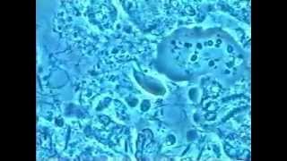 7 Kyste amibe trophozoites amibes globules blancs et Trichomonas dans les parodontites [upl. by Husain]