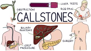 Understanding Gallstones [upl. by Glenden]