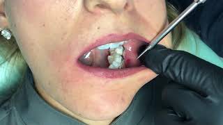 Miniimplante extraalveolar em buccal shelf [upl. by Deland]