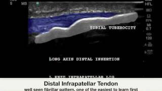 Knee Infrapatellar Enthesopathy  Sonosite Case Study [upl. by Noguchi]