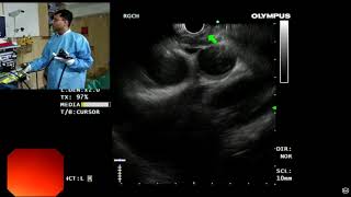 EUS Anatomy of mediastinum [upl. by Burd]