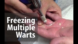 Freezing Multiple Warts  Utah Valley Dermatology [upl. by Bailie884]