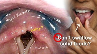 Causes and treatment of swallowing problems  Dr Anita Krishnan [upl. by Eissirk492]