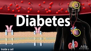 Diabetes mellitus  Symptoms Complication Pathology of Type 1 and Type 2 Animation [upl. by Tergram80]