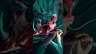 craniotomy surgeryshort video virallike share Subscribe amp follow 👍 [upl. by Aniles]