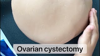 Ultrasound guided Ovarian Cyst Aspiration and Sclerotherapy Management of Ovarian Cysts Aspiration [upl. by Bayard]