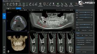 Dental Analysis Software Rotulagem do canal radicular [upl. by Rudyard]