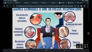 UE1 Sémiologie respiratoire  Les Signes fonctionnels Part 1 La Dyspnée [upl. by Inig]