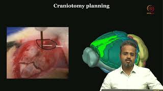 Lec 19 Craniotomy and Cranial Window Surgeries [upl. by Lahcsap274]