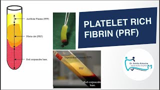 PLATELET RICH FIBRIN PRF IN PERIODONTICS BIOLOGIC PROPERTIES PREPARATION PRF MEMBRANE PRF PLUG [upl. by Ayalat]