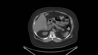 Acute cholecystitis with tensile fundus sign [upl. by Oirogerg]