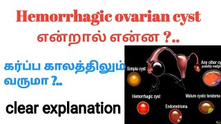 Hemorrhagic ovarian cyst in tamil  corpus luteum cyst in tamil  causes and symptoms of hemorrhage [upl. by Gwen]