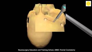 Neurosurgery 3D Animation Video  Frontal Craniotomy [upl. by Rivy]