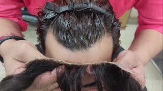 Frontline Hair Patch for Men in Delhi  Amazing Hair Replacement Process 📱 9899746489 [upl. by Shaina]