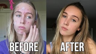 FROM SPOT TO HOT My Acne Story [upl. by Landbert]