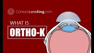 What is Orthokeratology or OrthoK [upl. by Spaulding730]