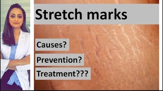 Stretch marks causes prevention treatment  Dermatologist  Dr Aanchal Panth [upl. by Cacie725]